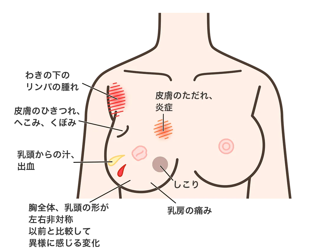代表的な症状は、乳房のしこり