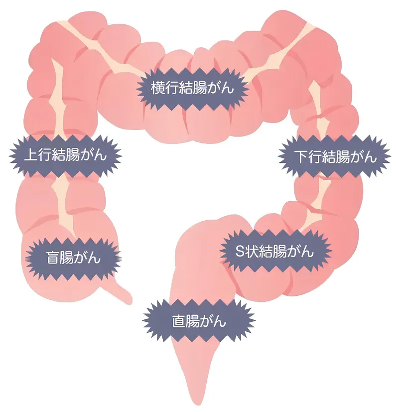 大腸がんの部位