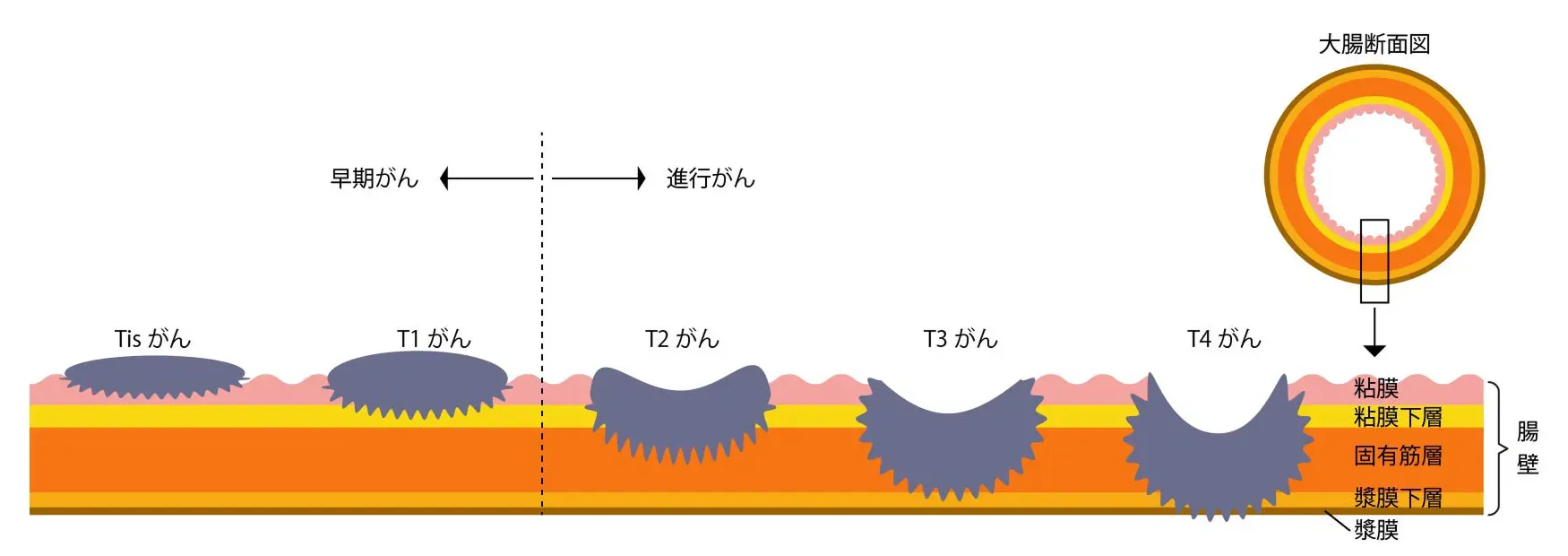 大腸がんの深達度による分類