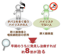 肺がんは早期発見し治療すれば約8割が治るようになりました