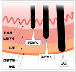 胃がんが発生しやすい場所の図